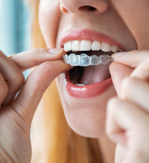 3-Things-to-Know-Before-Starting-Invisalign-Treatment
