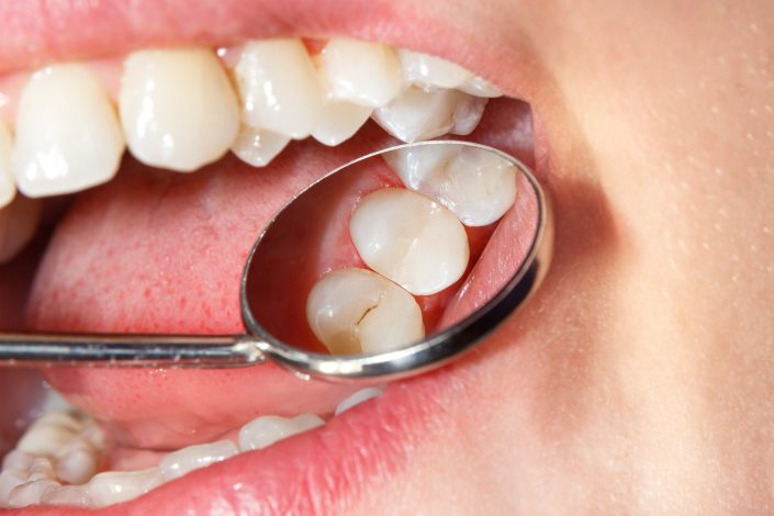 Enamel-Dental-Fillings-Penticton-Dentist