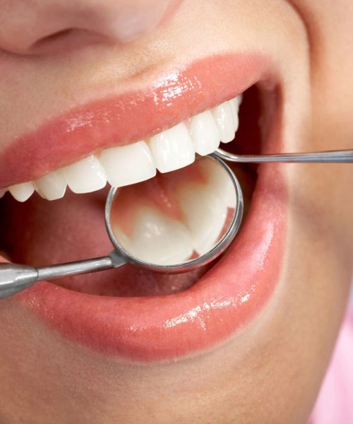 Fisher-Pointe-_-Blog-Dental-Filling-Procedure-Steps