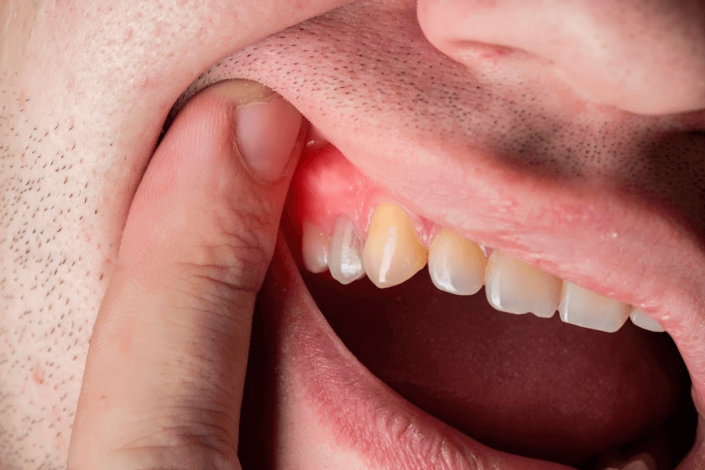 Is-Gum-Disease-Contagious