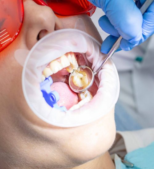 Sedation-Options-For-Wisdom-Teeth-Extraction