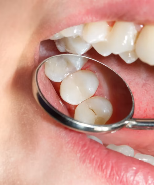 dental-caries-filling-composite-photopolymer-material