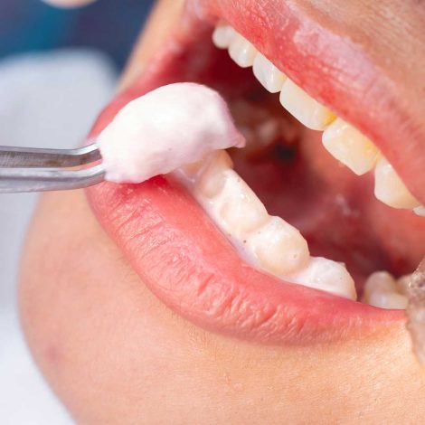 fluoride-treatment-2